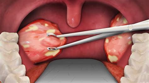 tonsillitis surgery